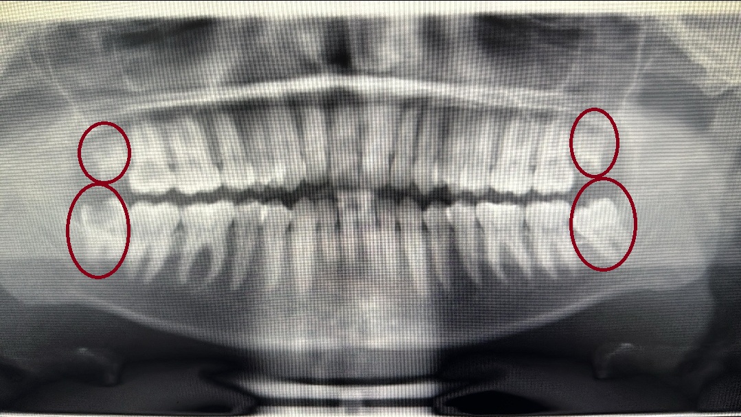 Wisdom teeth procedure illustration